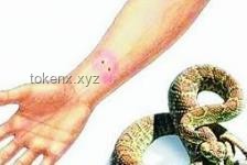被蛇咬后应急处理方案