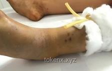 被蛇咬后应急处理方案
